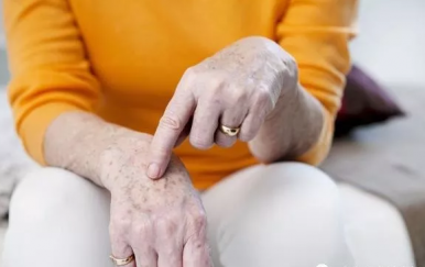 皮膚長老年斑怎么去掉，學(xué)會4招“吃”掉老年斑