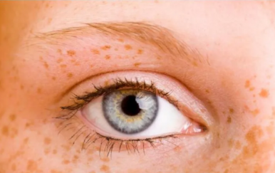 女人黃褐斑是怎么形成的？主要與這幾大因素有關(guān)