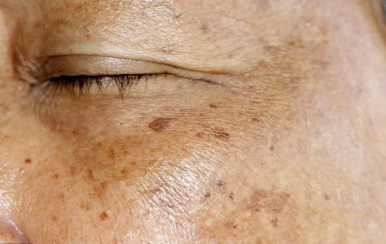 可怕的是老年斑，90后也不放過(guò)