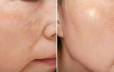 都說(shuō)祛斑難，對(duì)不起，那是他因?yàn)槟銢](méi)選對(duì)方法！